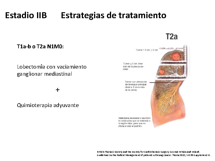 Estrategias de tratamiento Estadio IIB T 1 a-b o T 2 a N 1