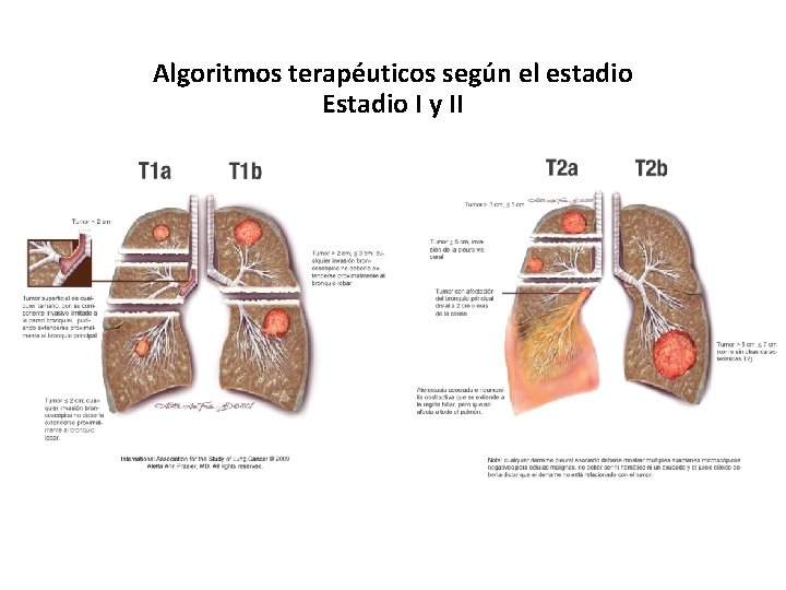 Algoritmos terapéuticos según el estadio Estadio I y II 