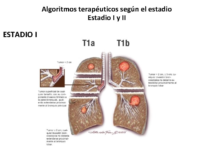 Algoritmos terapéuticos según el estadio Estadio I y II ESTADIO I 