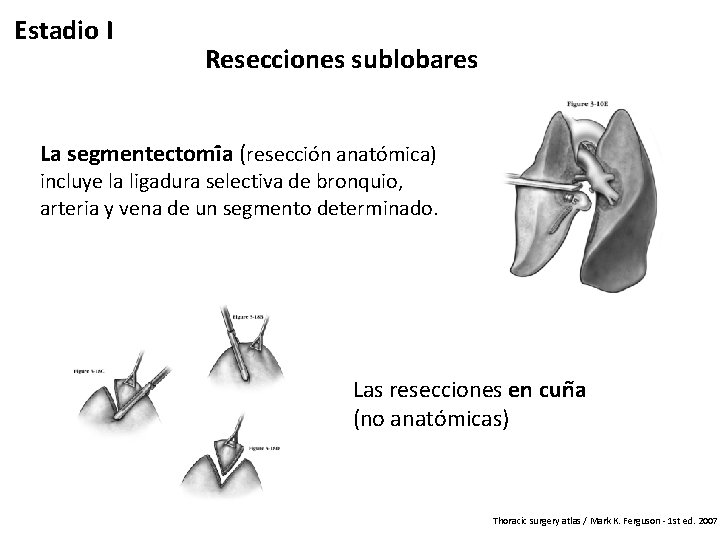 Estadio I Resecciones sublobares La segmentectomi a (reseccio n anato mica) incluye la ligadura