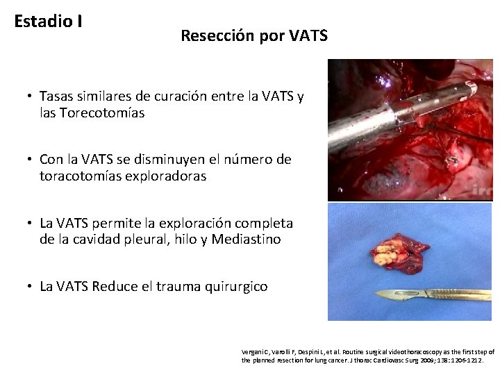 Estadio I Reseccio n por VATS • Tasas similares de curación entre la VATS