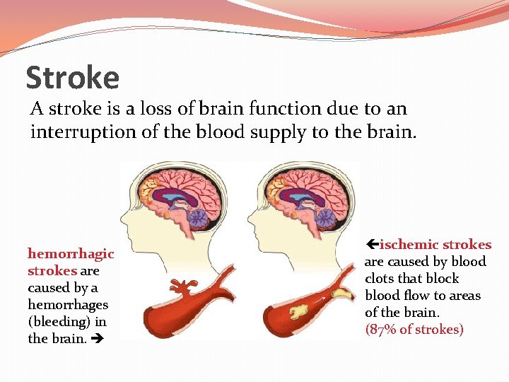 Stroke A stroke is a loss of brain function due to an interruption of