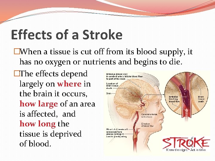 Effects of a Stroke �When a tissue is cut off from its blood supply,