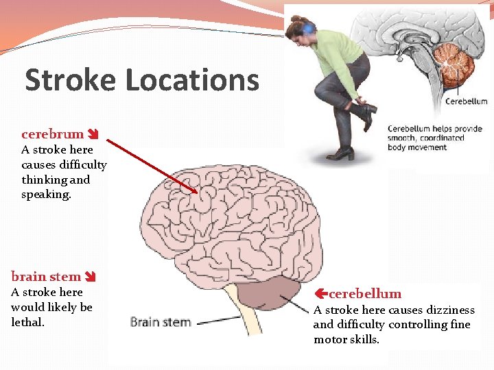 Stroke Locations cerebrum A stroke here causes difficulty thinking and speaking. brain stem A