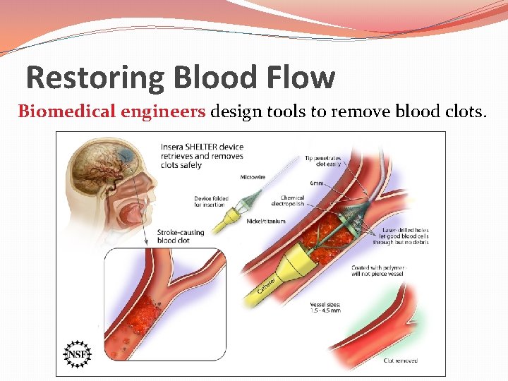 Restoring Blood Flow Biomedical engineers design tools to remove blood clots. 