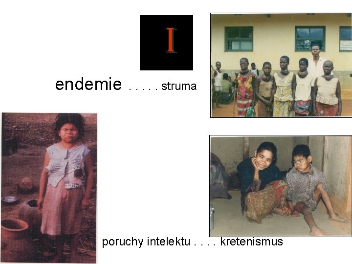  I endemie . . . struma poruchy intelektu. . kretenismus 