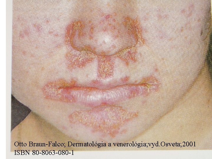 Otto Braun-Falco; Dermatológia a venerológia; vyd. Osveta; 2001 ISBN 80 -8063 -080 -1 