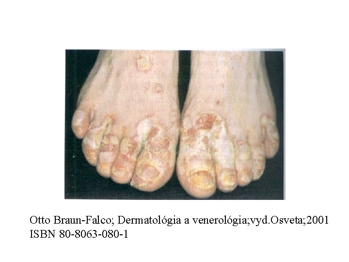 Otto Braun-Falco; Dermatológia a venerológia; vyd. Osveta; 2001 ISBN 80 -8063 -080 -1 