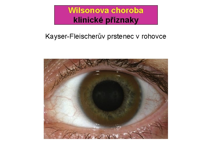 Wilsonova choroba klinické příznaky Kayser-Fleischerův prstenec v rohovce 