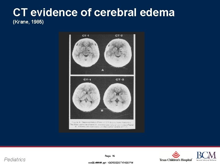 CT evidence of cerebral edema (Krane, 1985) Pediatrics Page 16 xxx 00. #####. ppt