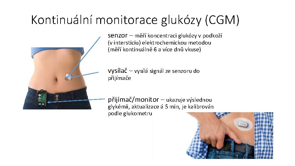 Kontinuální monitorace glukózy (CGM) senzor – měří koncentraci glukózy v podkoží (v intersticiu) elektrochemickou