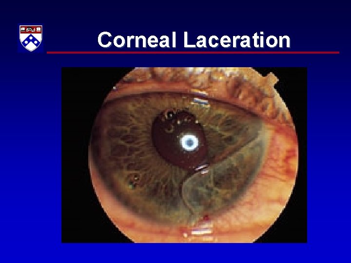 Corneal Laceration 