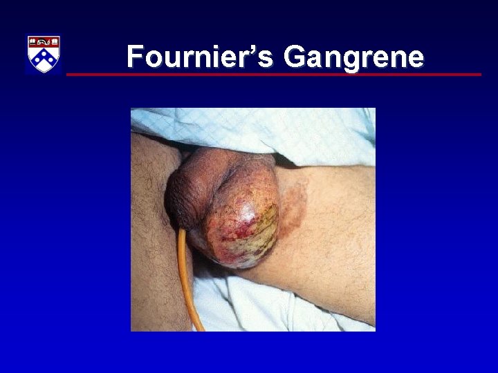 Fournier’s Gangrene 