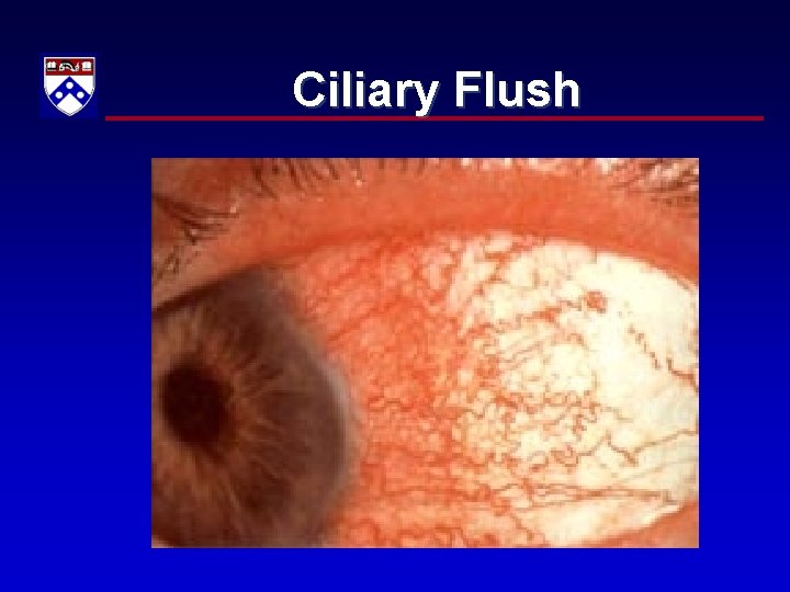 Ciliary Flush 