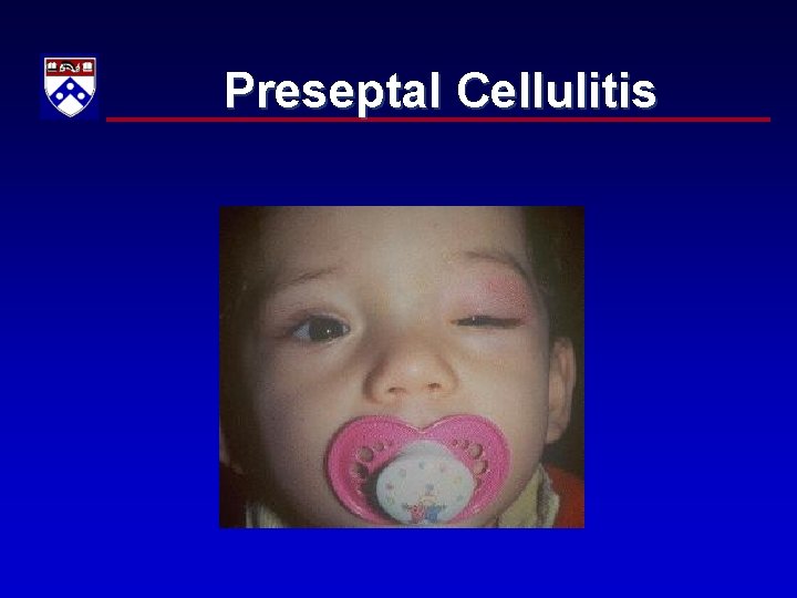 Preseptal Cellulitis 