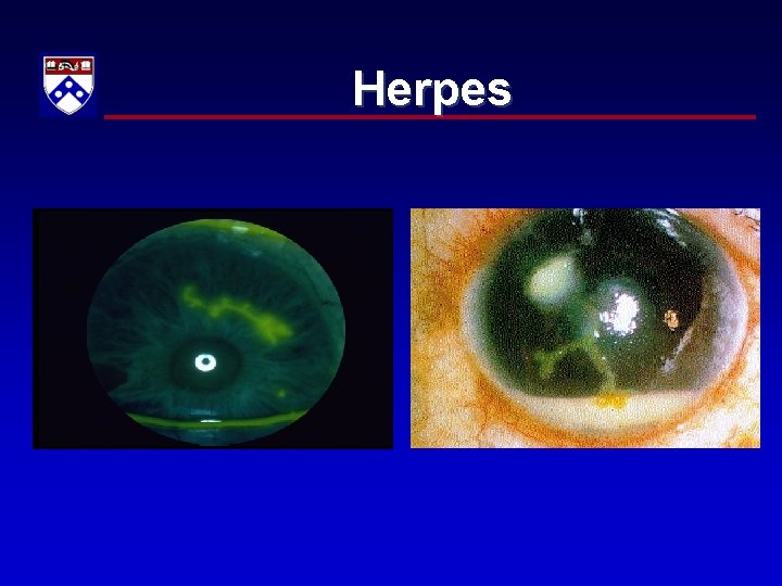 Herpes 