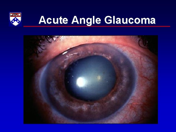 Acute Angle Glaucoma 