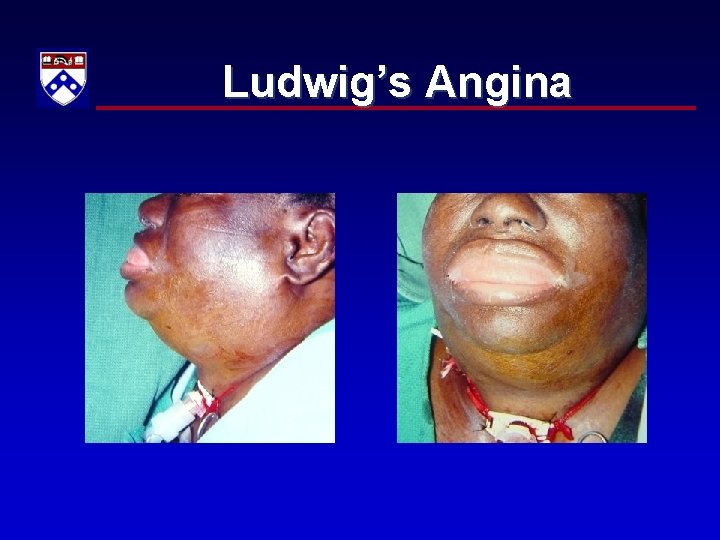 Ludwig’s Angina 