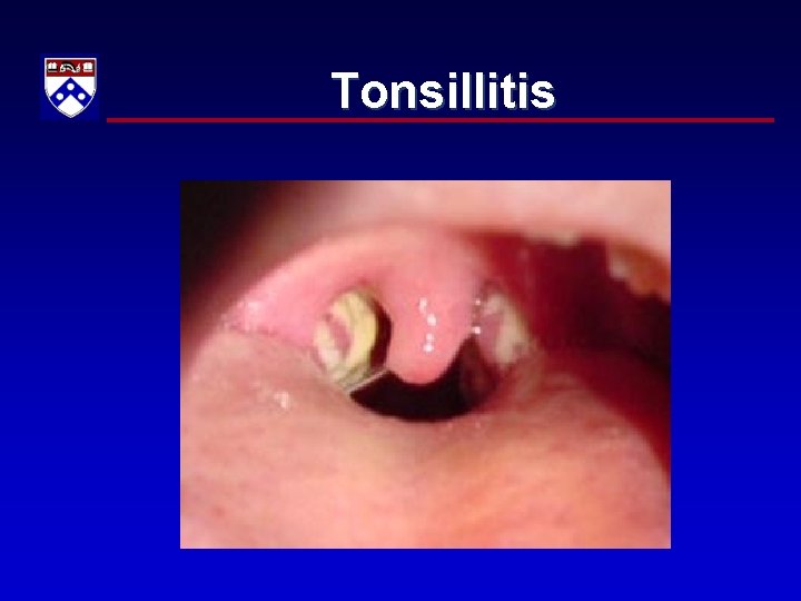 Tonsillitis 