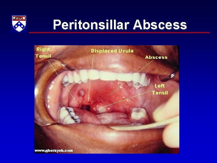 Peritonsillar Abscess 