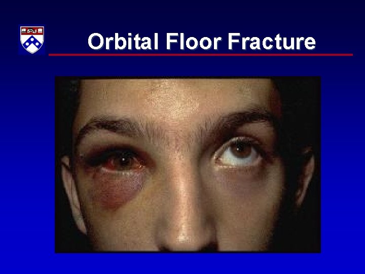Orbital Floor Fracture 
