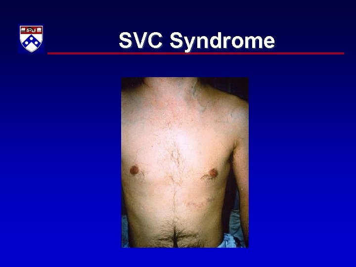 SVC Syndrome 