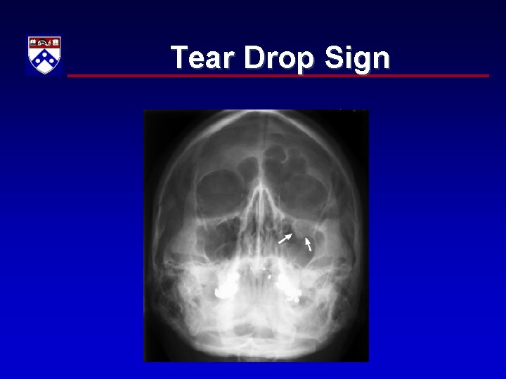 Tear Drop Sign 