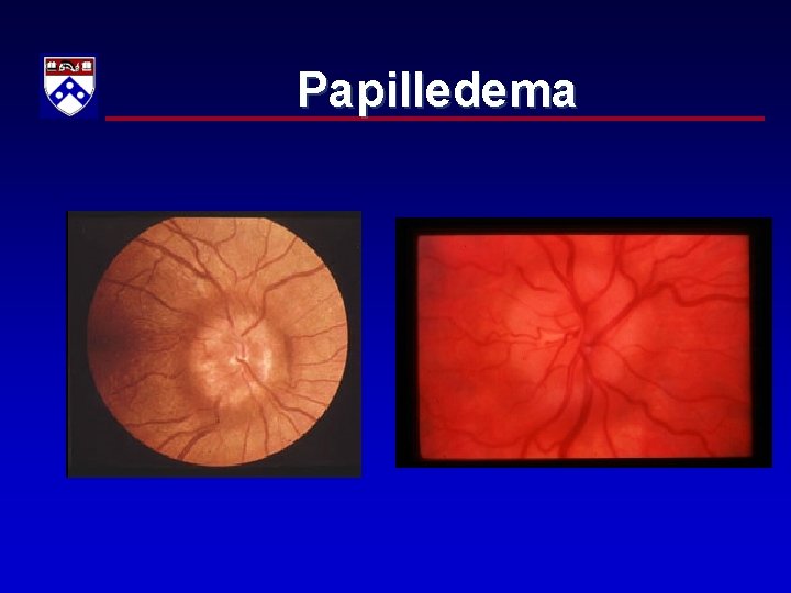 Papilledema 