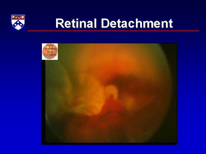 Retinal Detachment 
