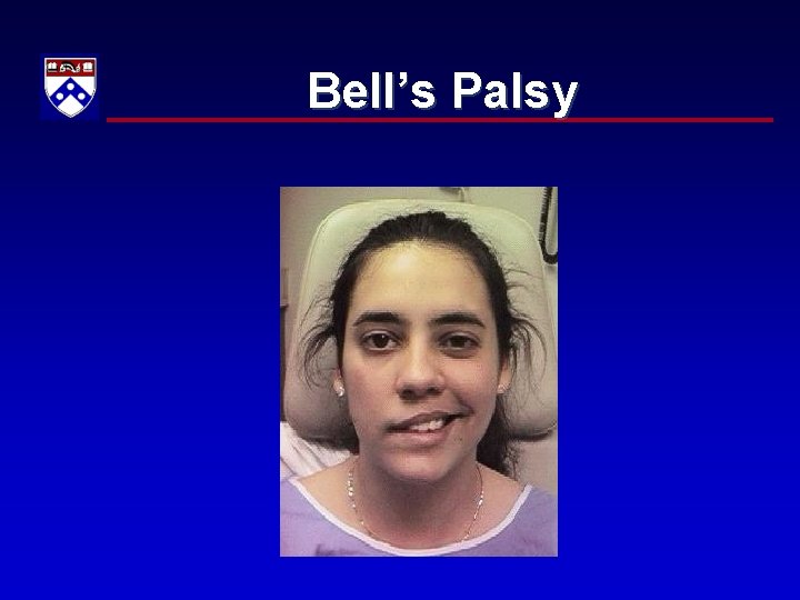 Bell’s Palsy 