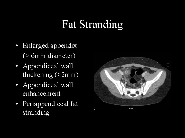 Fat Stranding • Enlarged appendix (> 6 mm diameter) • Appendiceal wall thickening (>2