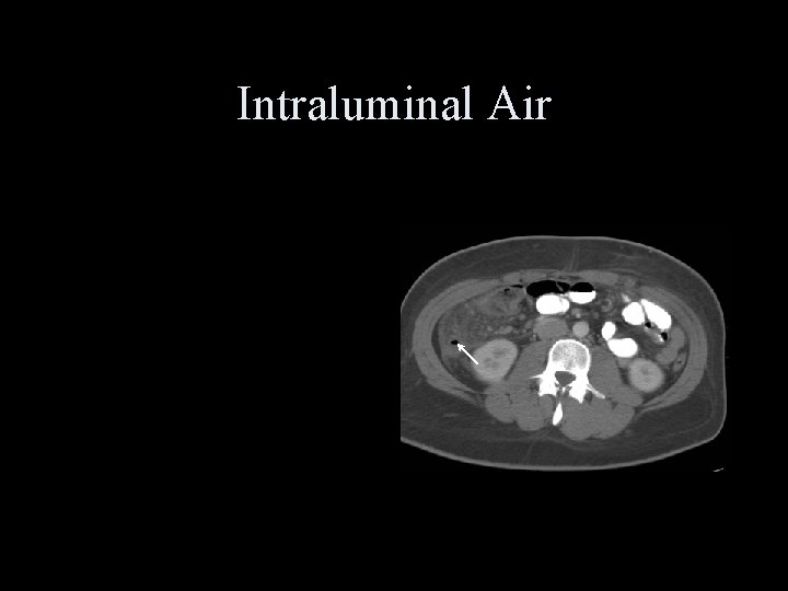 Intraluminal Air 