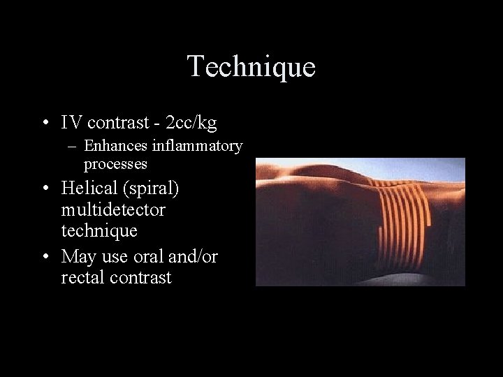 Technique • IV contrast - 2 cc/kg – Enhances inflammatory processes • Helical (spiral)