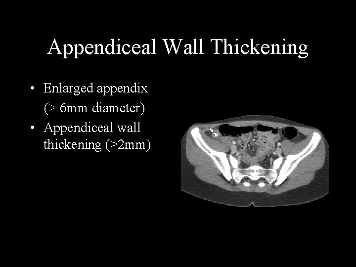 Appendiceal Wall Thickening • Enlarged appendix (> 6 mm diameter) • Appendiceal wall thickening