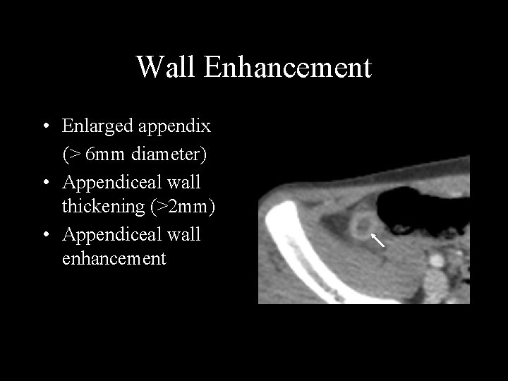 Wall Enhancement • Enlarged appendix (> 6 mm diameter) • Appendiceal wall thickening (>2