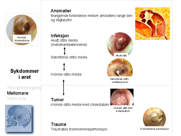 Anomalier Manglende forbindelse mellom amboltens lange ben og stigbøylen Normal trommehinne Infeksjon Akutt otitis
