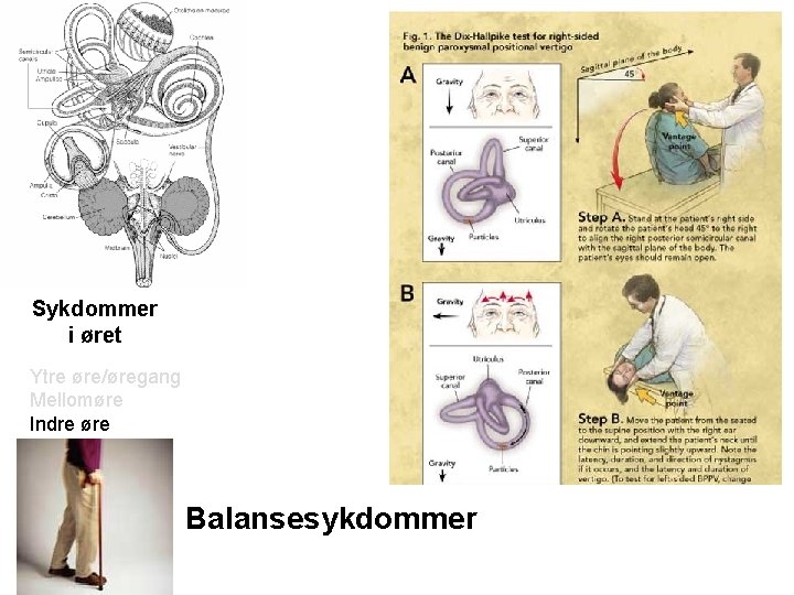 Sykdommer i øret Ytre øre/øregang Mellomøre Indre øre Balansesykdommer 