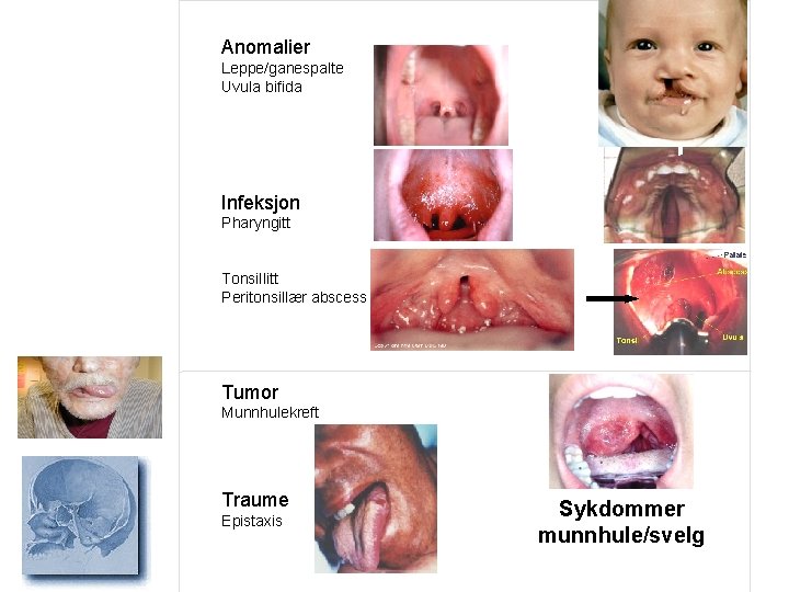 Anomalier Leppe/ganespalte Uvula bifida Infeksjon Pharyngitt Tonsillitt Peritonsillær abscess Tumor Munnhulekreft Traume Epistaxis Sykdommer