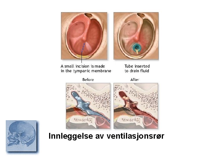 Innleggelse av ventilasjonsrør 