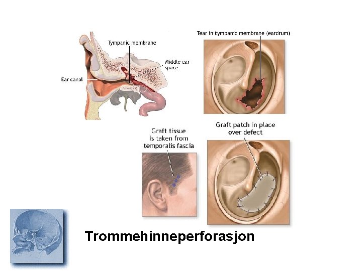 Trommehinneperforasjon 