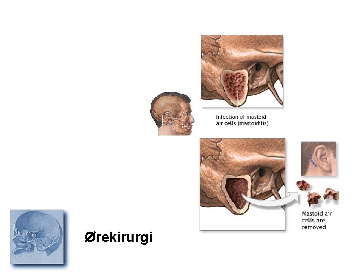 Ørekirurgi 