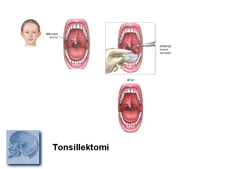 Tonsillektomi 
