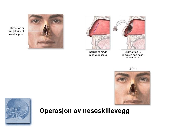 Operasjon av neseskillevegg 