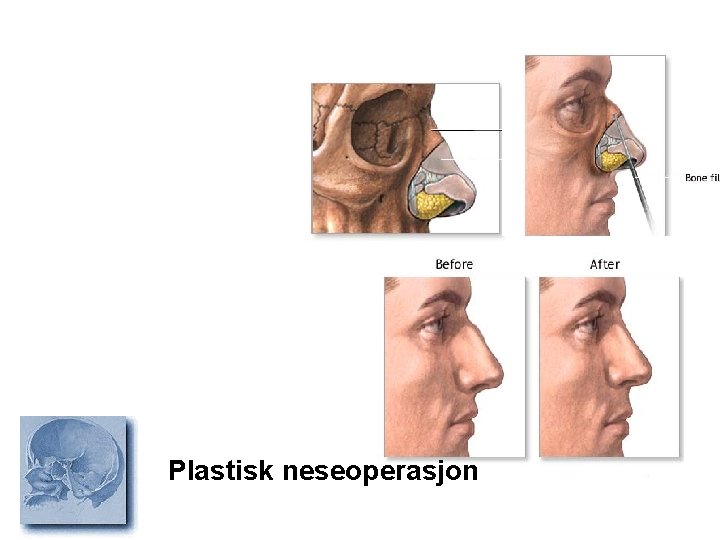 Plastisk neseoperasjon 