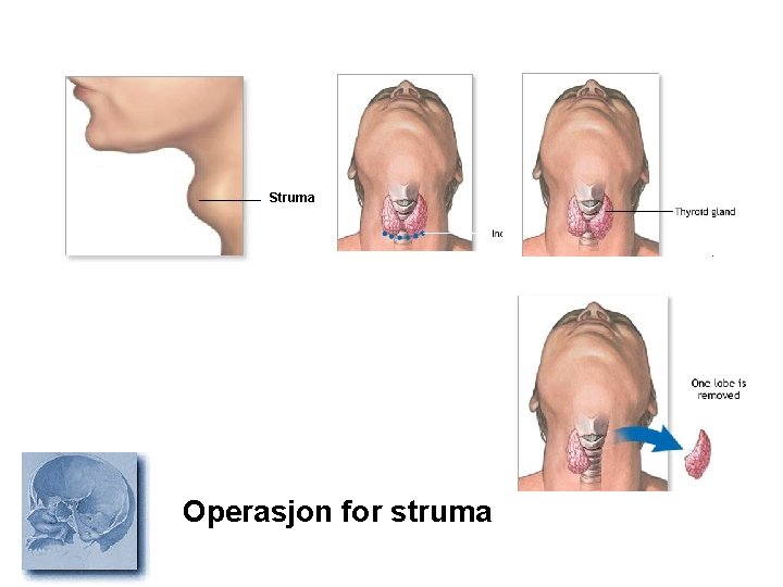 Struma Operasjon for struma 