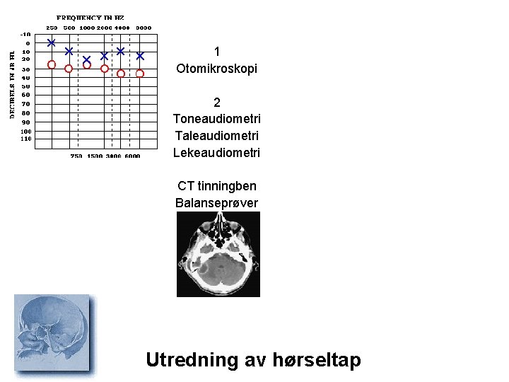 1 Otomikroskopi 2 Toneaudiometri Taleaudiometri Lekeaudiometri CT tinningben Balanseprøver Utredning av hørseltap 