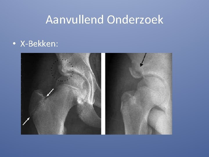 Aanvullend Onderzoek • X-Bekken: 