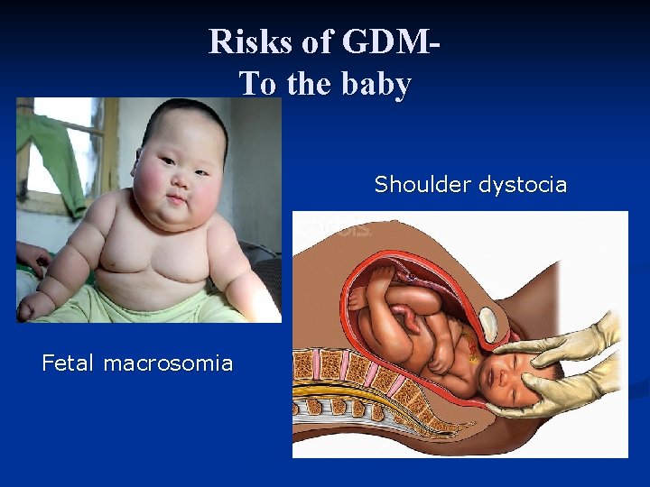 Risks of GDMTo the baby Shoulder dystocia Fetal macrosomia 
