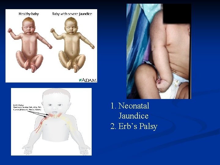 1. Neonatal Jaundice 2. Erb’s Palsy 