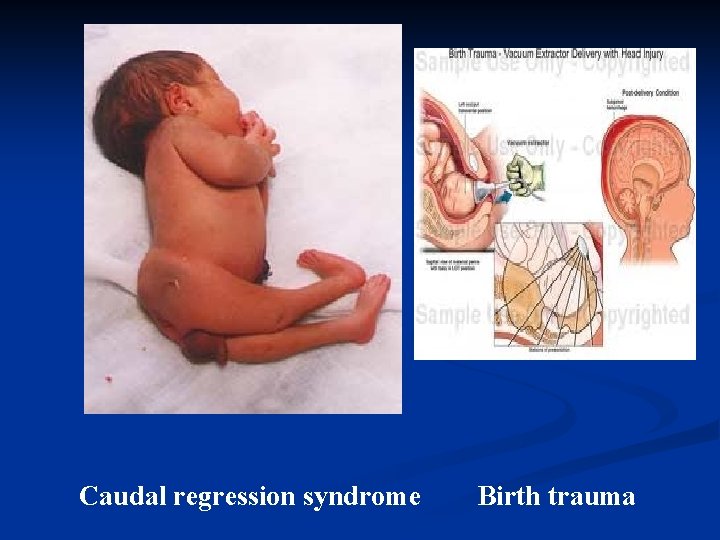 Caudal regression syndrome Birth trauma 